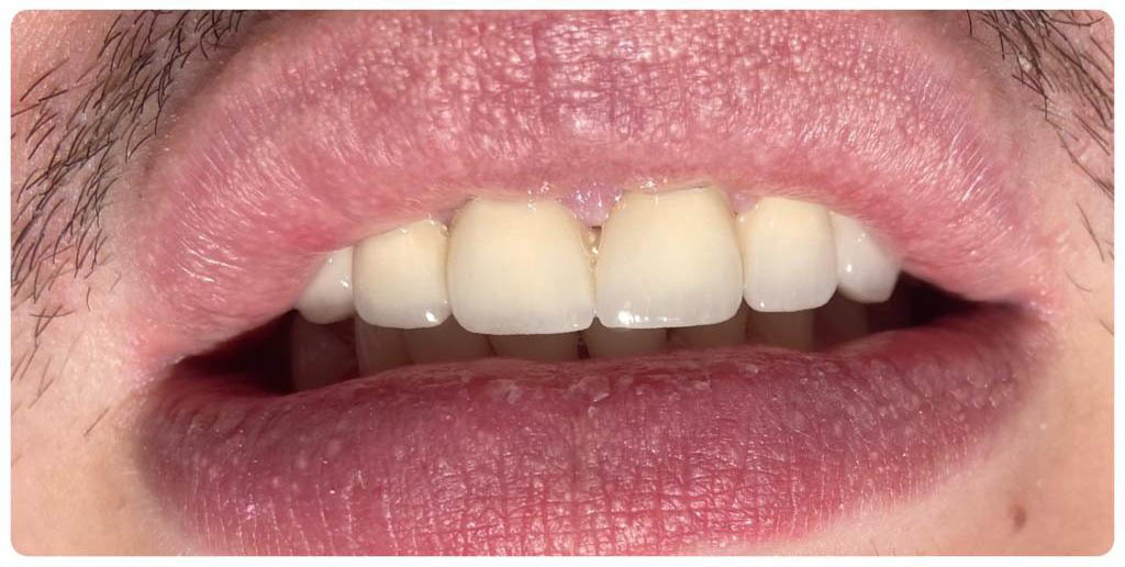 After-Pacient cu multiple carii si suras inestetic - Estetica refacuta prin tratamente odontoterapeutice, endodontice si coroane ceramica pe metal.