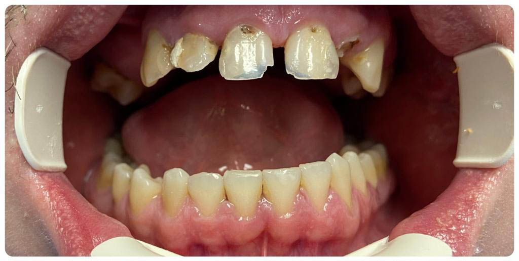 Before-Pacient cu multiple carii si suras inestetic - Estetica refacuta prin tratamente odontoterapeutice, endodontice si coroane ceramica pe metal.