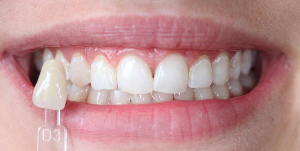 After-Albire dentara