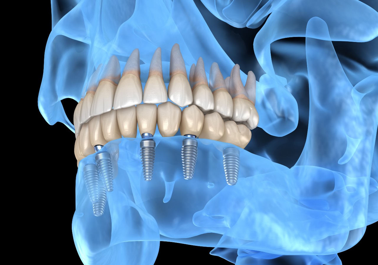 Implant dentar Cluj